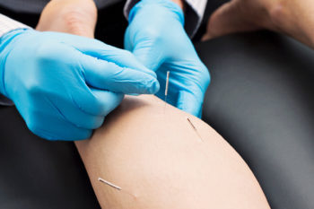 What is Dry Needling and How Can it Help Me?